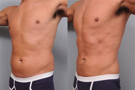 male liposuction miami|Liposuction for Men Miami 